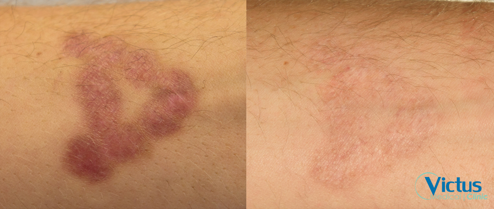 Arr_foe_fraxium15501