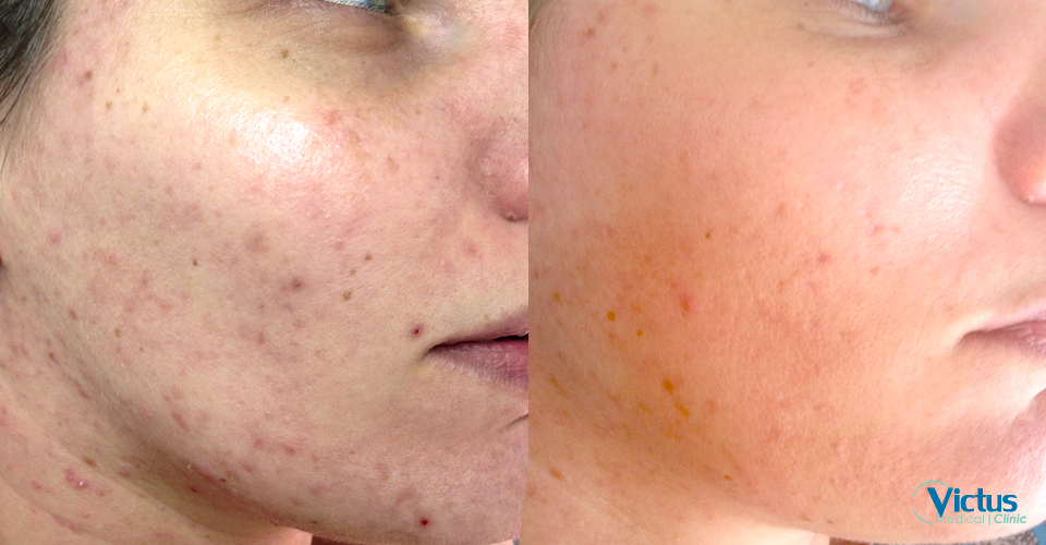 akne_foe_fraxium_1beh