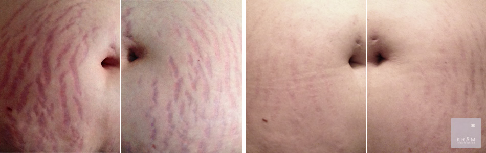 fore-after-fraxium-bristningar-kram