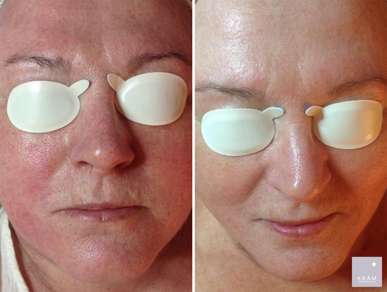 fore-efter-rosacea-4-beh