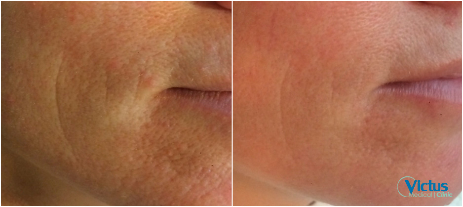 porer-1-behandling-fraxium